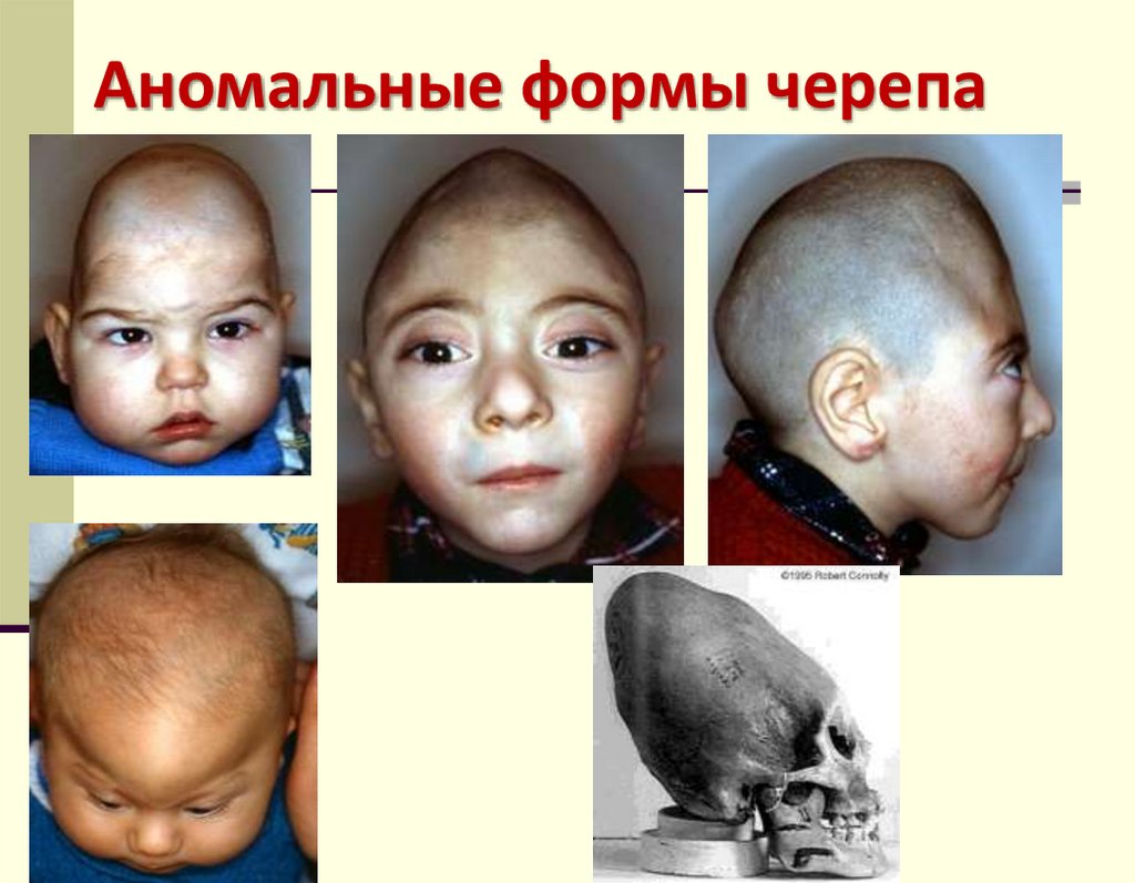 Аномальные формы черепа