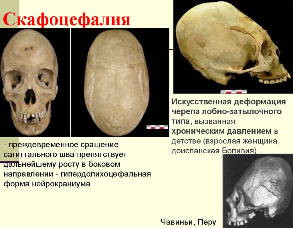 Скафоцефалия