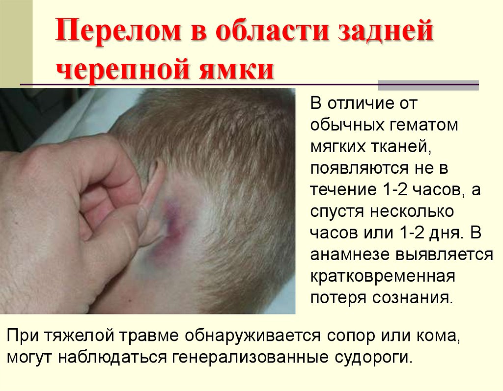 Перелом в области задней черепной ямки