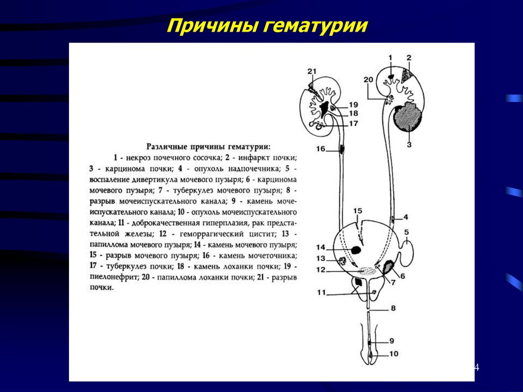 Причины гематурии
