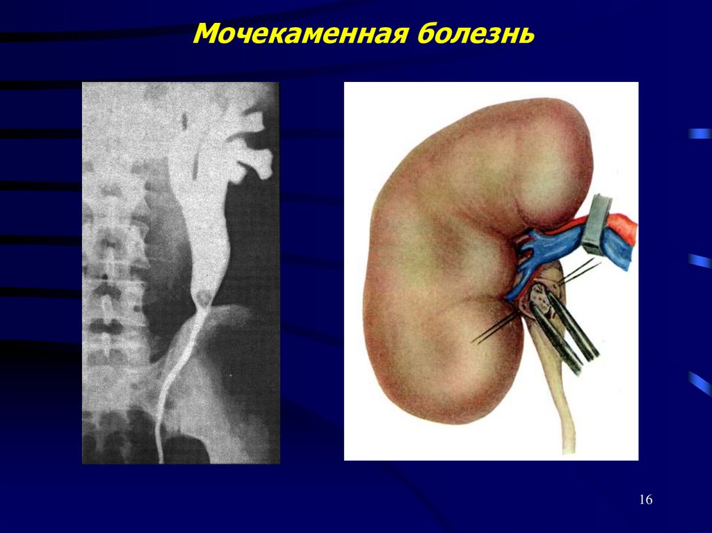 Мочекаменная болезнь