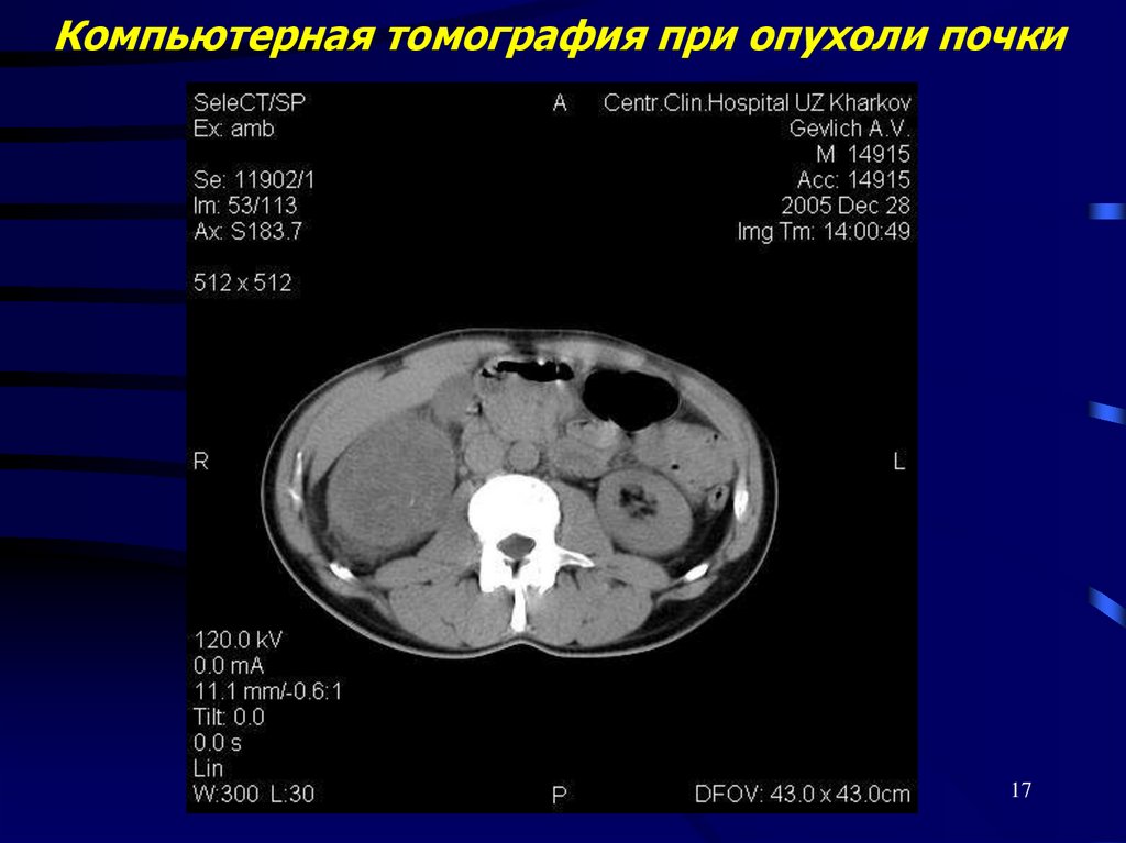 Компьютерная томография при опухоли почки