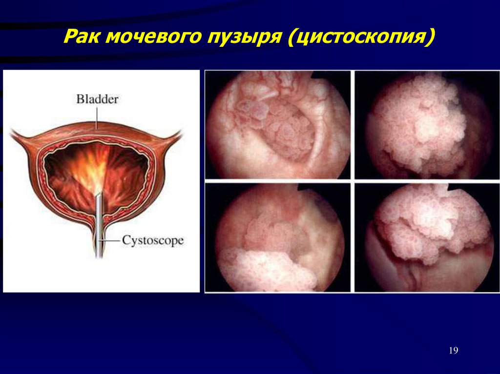 Рак мочевого пузыря (цистоскопия)