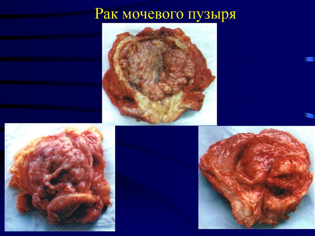 Рак мочевого пузыря