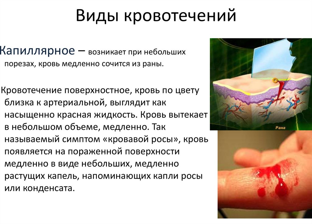 Виды кровотечений