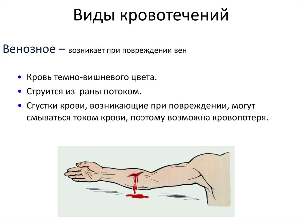 Виды кровотечений