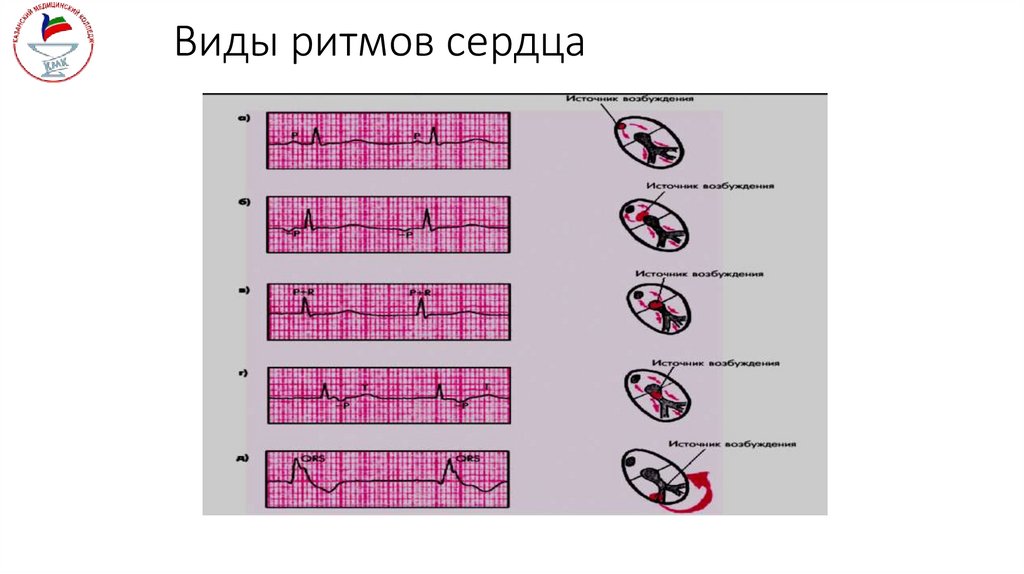 Виды ритмов сердца