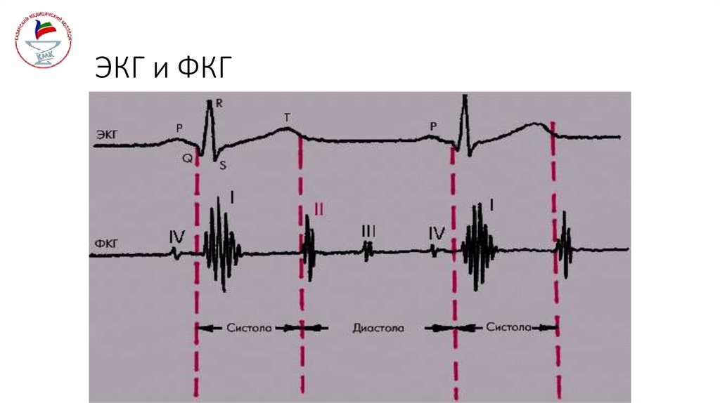 ЭКГ и ФКГ