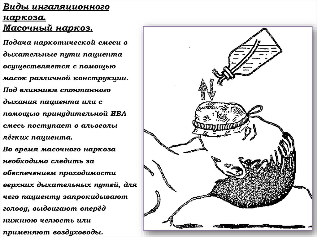 Виды ингаляционного наркоза. Масочный наркоз.