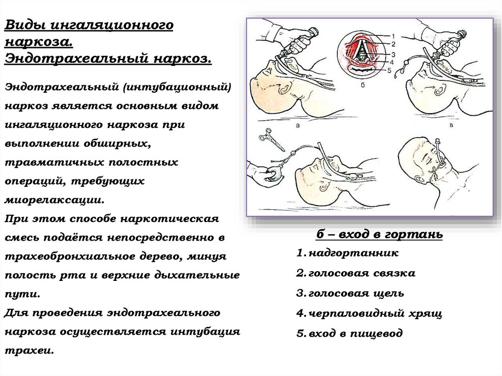 Виды ингаляционного наркоза. Эндотрахеальный наркоз.
