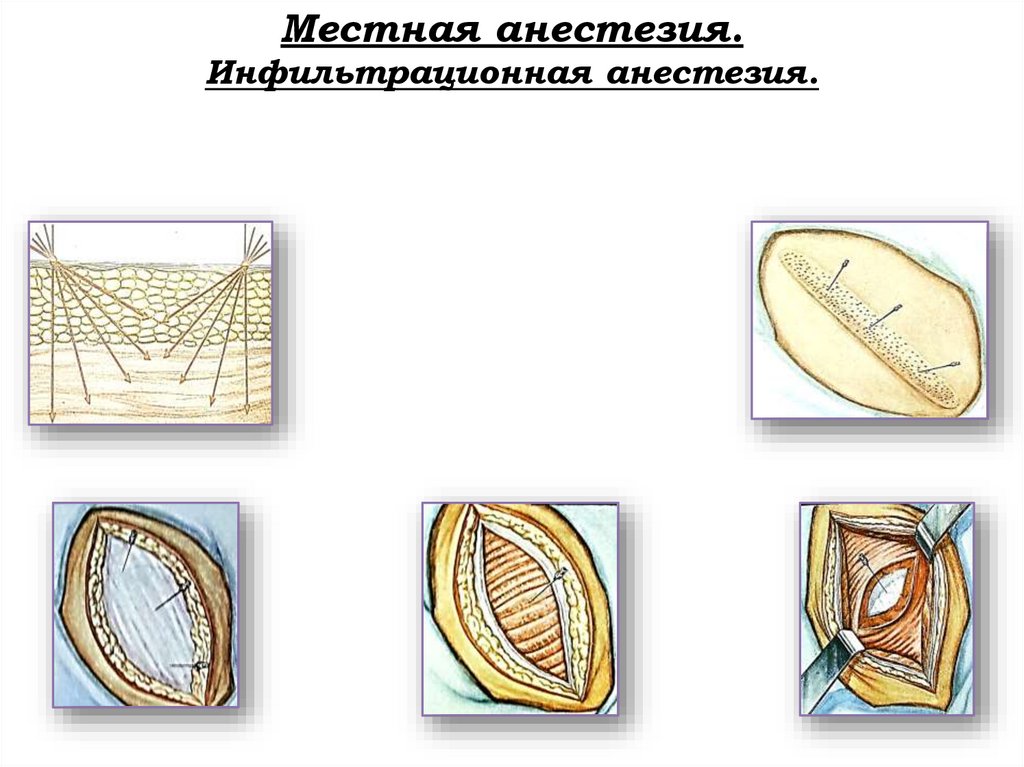 Местная анестезия. Инфильтрационная анестезия.