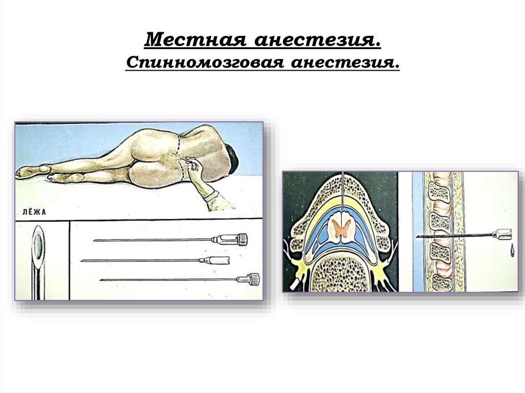 Местная анестезия. Спинномозговая анестезия.