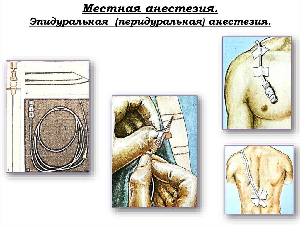 Местная анестезия. Эпидуральная (перидуральная) анестезия.