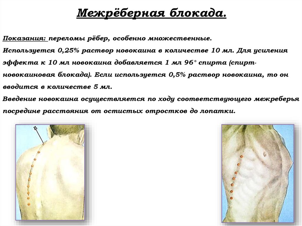 Межрёберная блокада. Показания: переломы рёбер, особенно множественные. Используется 0,25% раствор новокаина в количестве 10