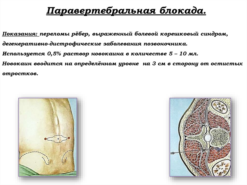 Паравертебральная блокада. Показания: переломы рёбер, выраженный болевой корешковый синдром, дегенеративно-дистрофические