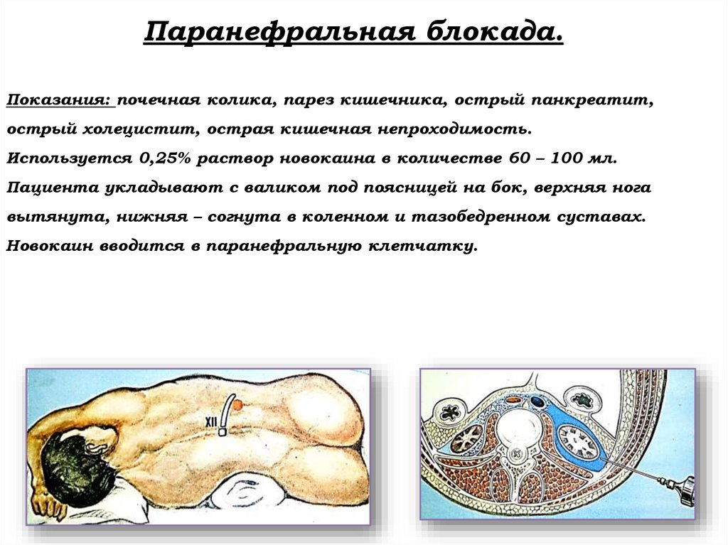Паранефральная блокада. Показания: почечная колика, парез кишечника, острый панкреатит, острый холецистит, острая кишечная
