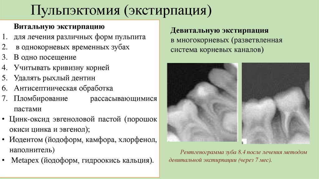 Пульпэктомия (экстирпация)