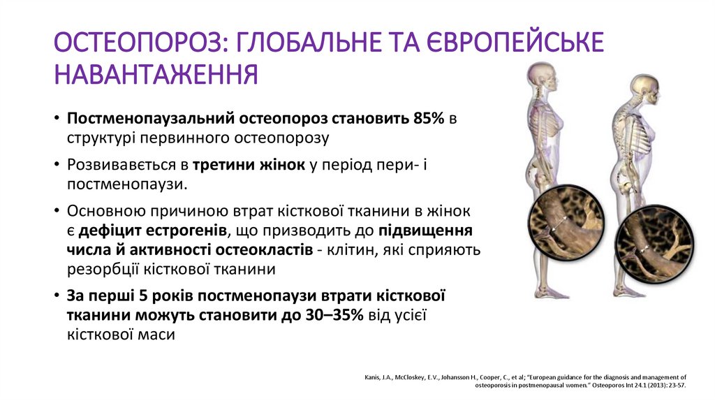 ОСТЕОПОРОЗ: ГЛОБАЛЬНЕ ТА ЄВРОПЕЙСЬКЕ НАВАНТАЖЕННЯ