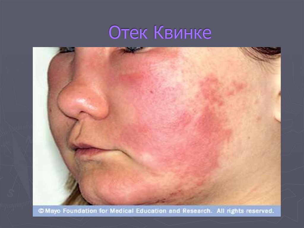 Отек Квинке