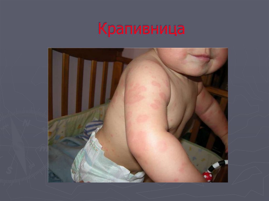 Крапивница