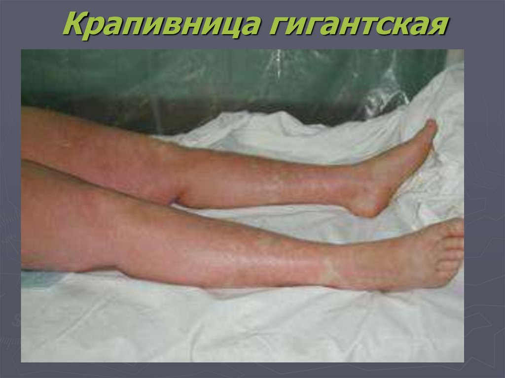 Крапивница гигантская