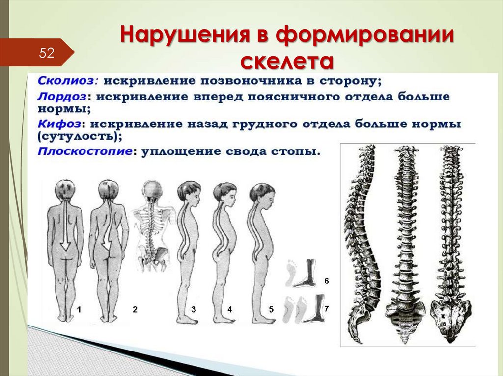 Нарушения в формировании скелета