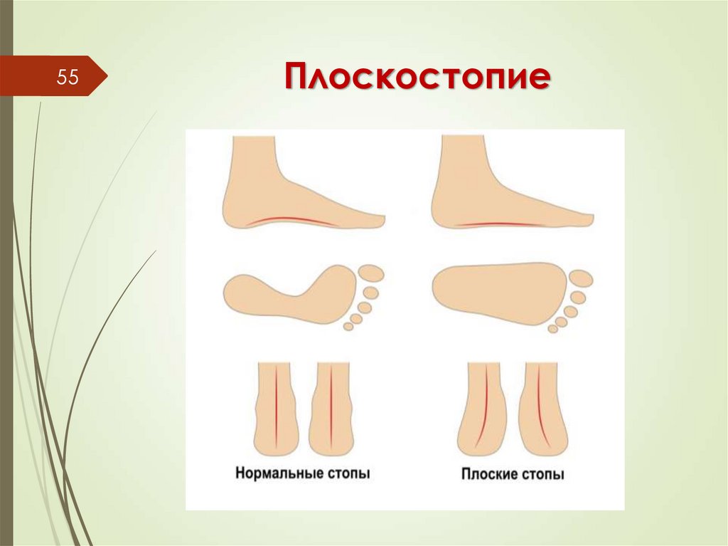 Плоскостопие