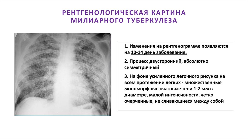 РЕНТГЕНОЛОГИЧЕСКАЯ КАРТИНА МИЛИАРНОГО ТУБЕРКУЛЕЗА