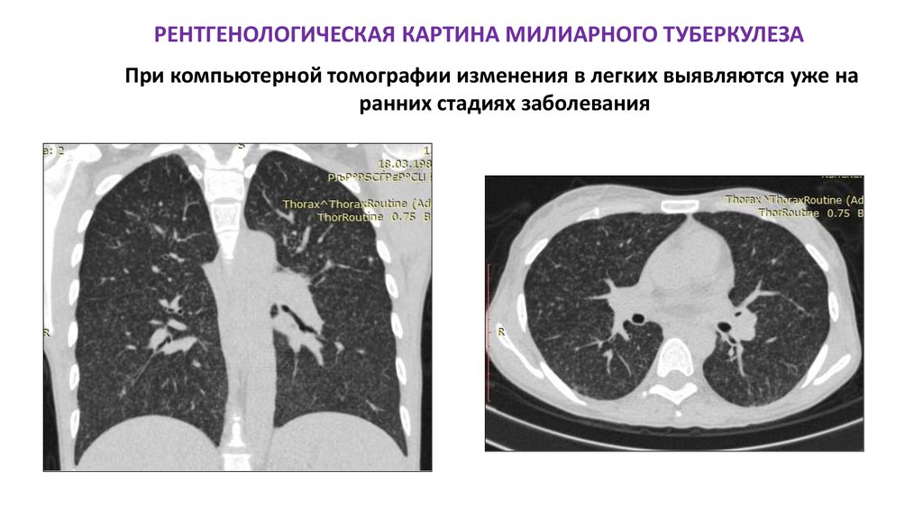 РЕНТГЕНОЛОГИЧЕСКАЯ КАРТИНА МИЛИАРНОГО ТУБЕРКУЛЕЗА