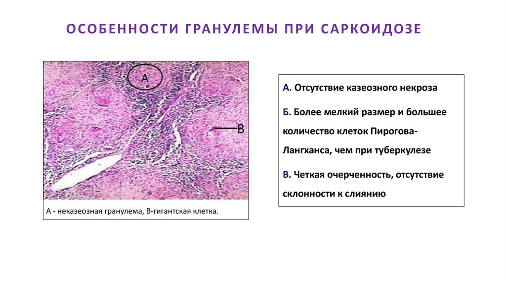 ОСОБЕННОСТИ ГРАНУЛЕМЫ ПРИ САРКОИДОЗЕ