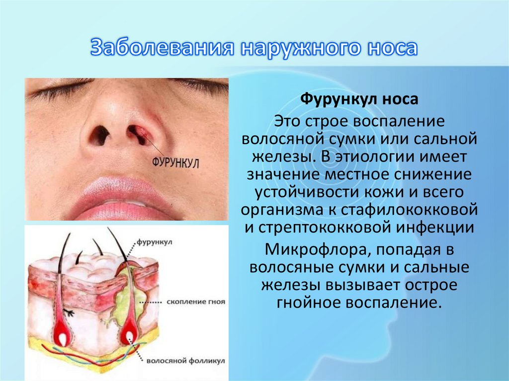 Заболевания наружного носа