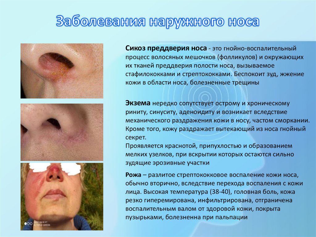 Заболевания наружного носа