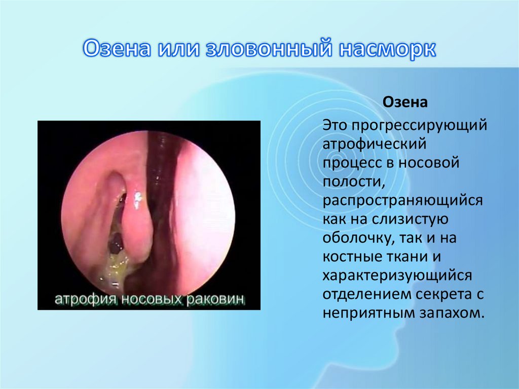 Озена или зловонный насморк