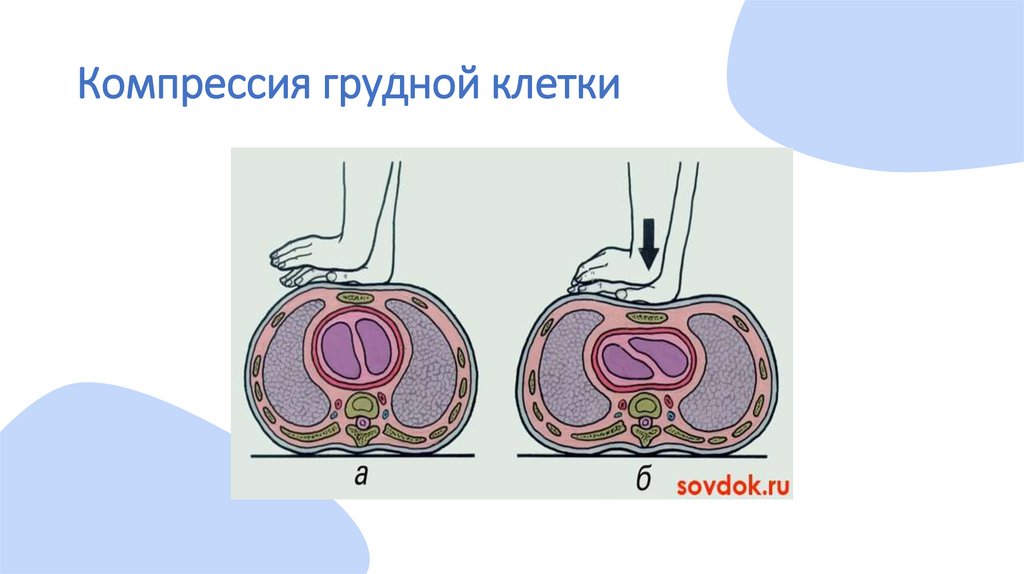 Компрессия грудной клетки