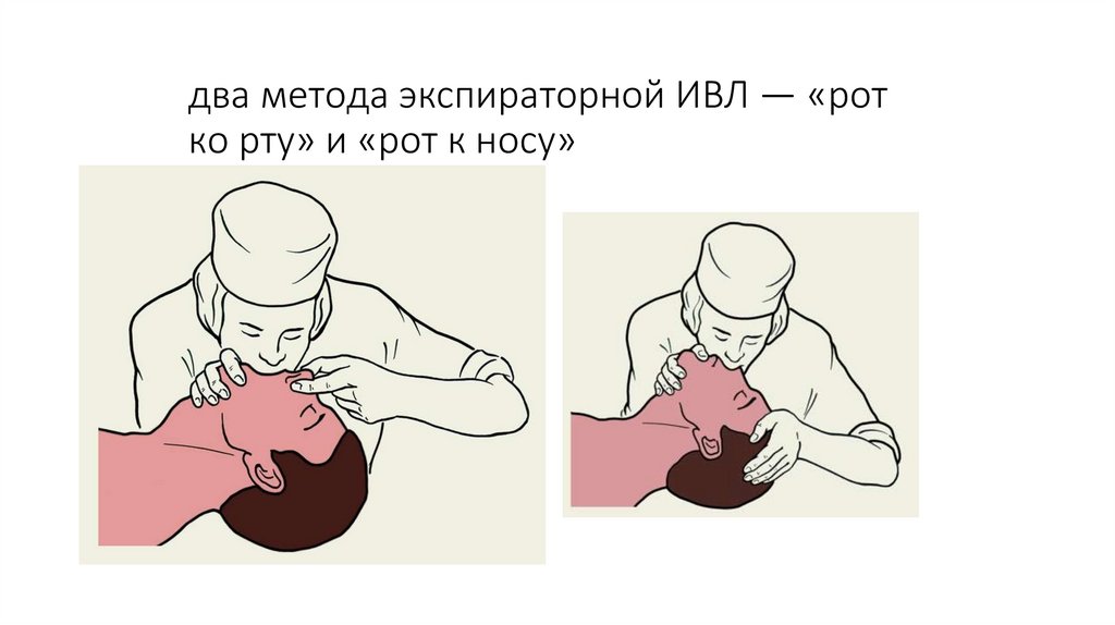 два метода экспираторной ИВЛ — «рот ко рту» и «рот к носу»