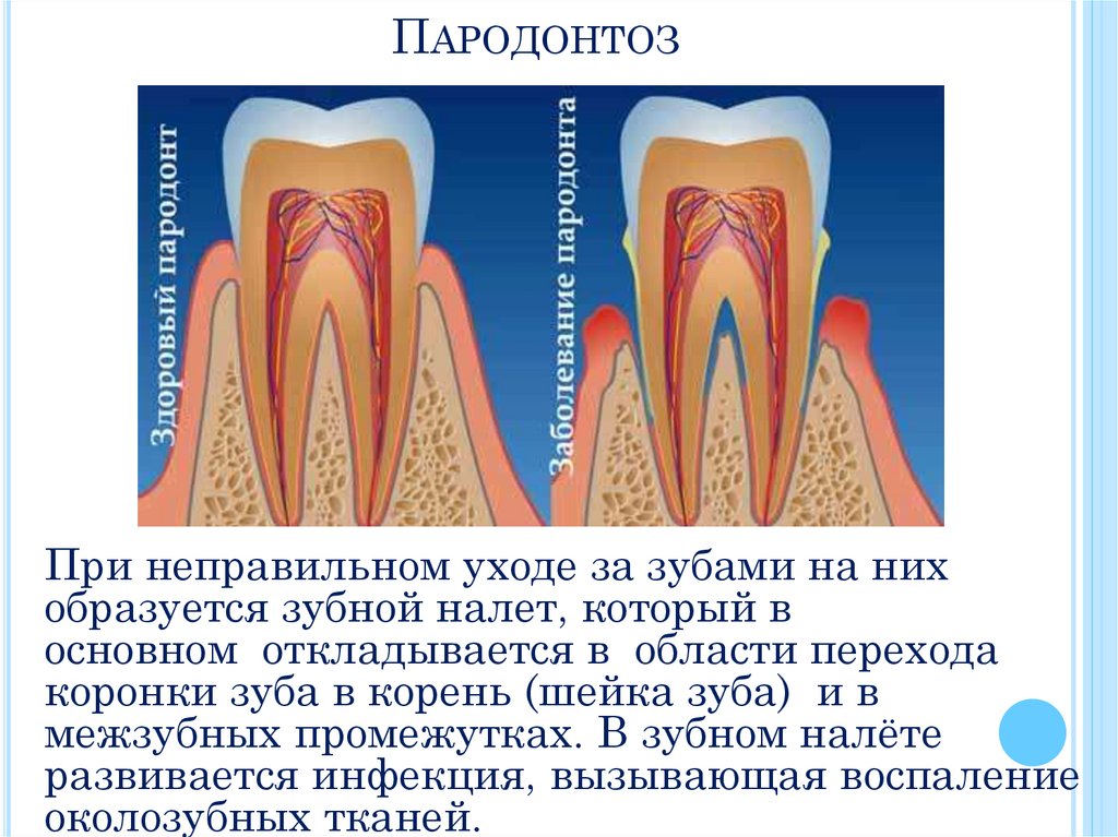 Пародонтоз