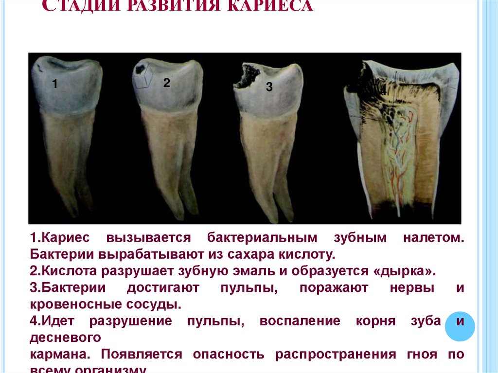 Стадии развития кариеса