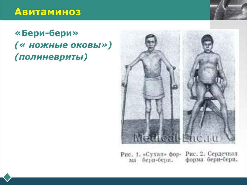 Авитаминоз