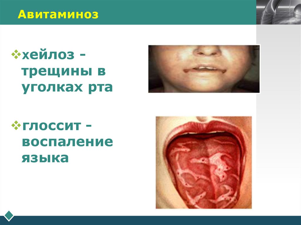 Авитаминоз