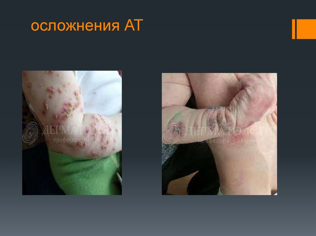 осложнения АТ