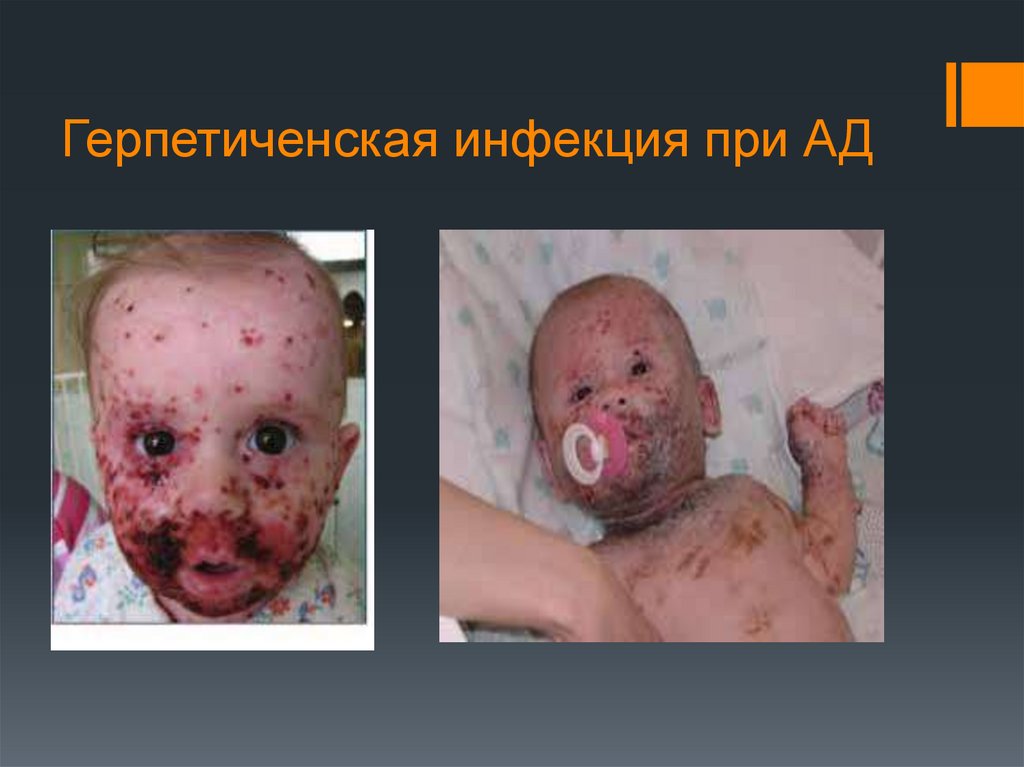 Герпетиченская инфекция при АД