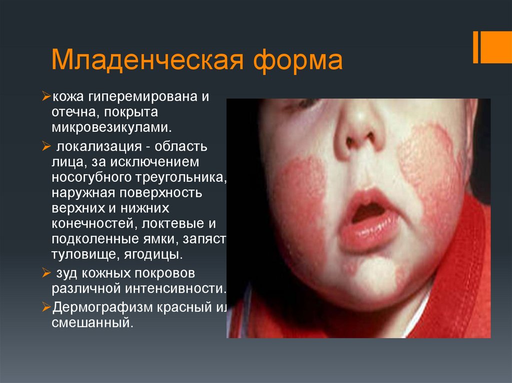 Младенческая форма