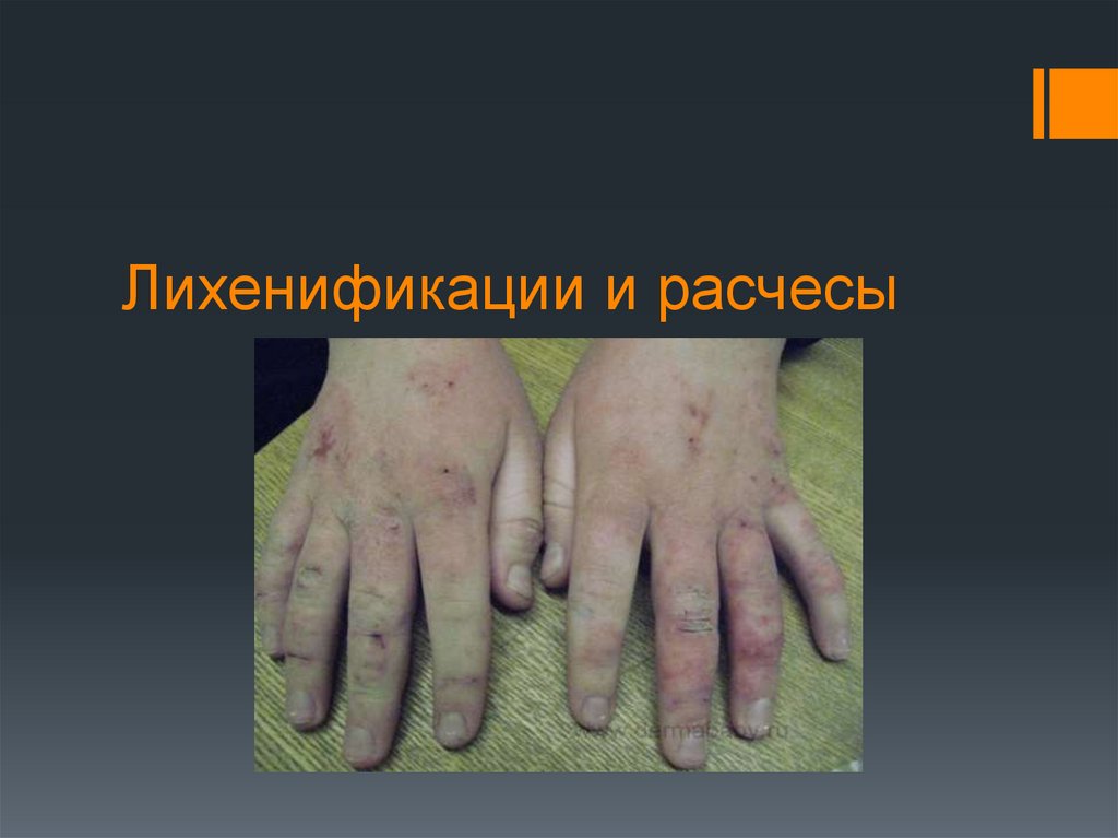 Лихенификации и расчесы