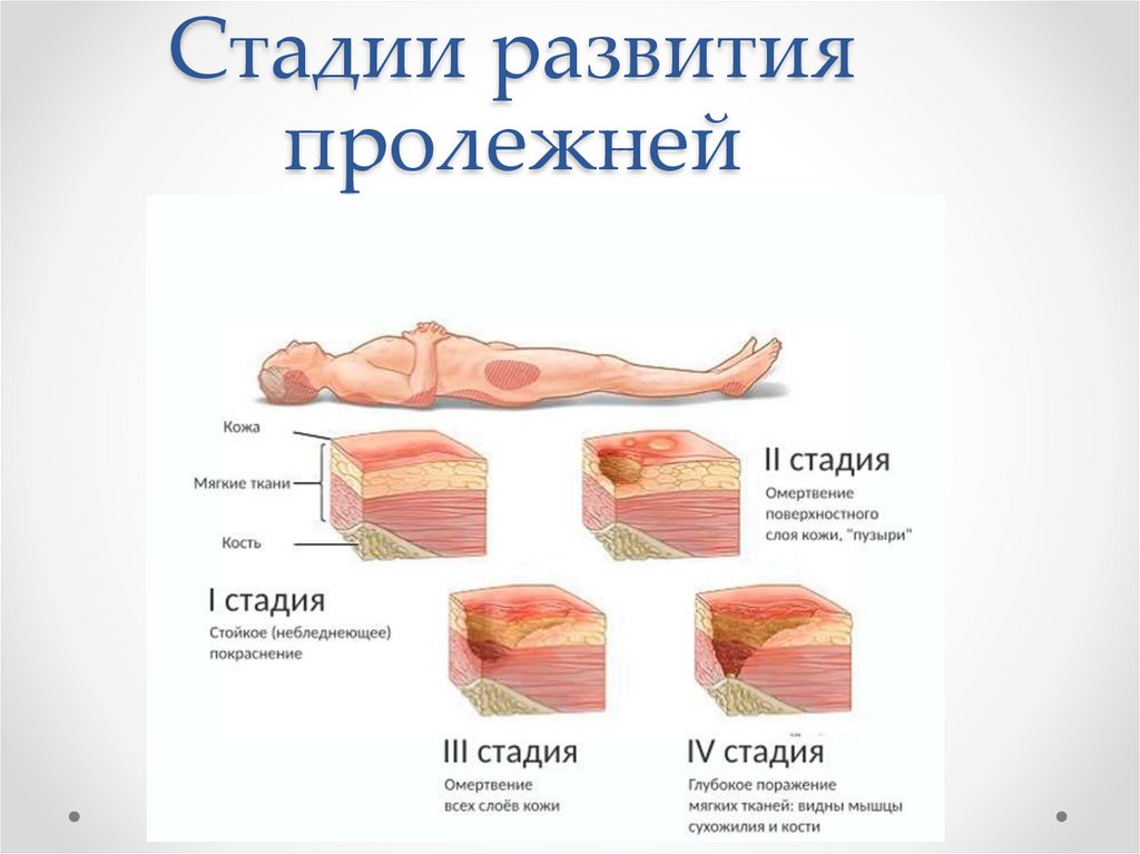 Стадии развития пролежней