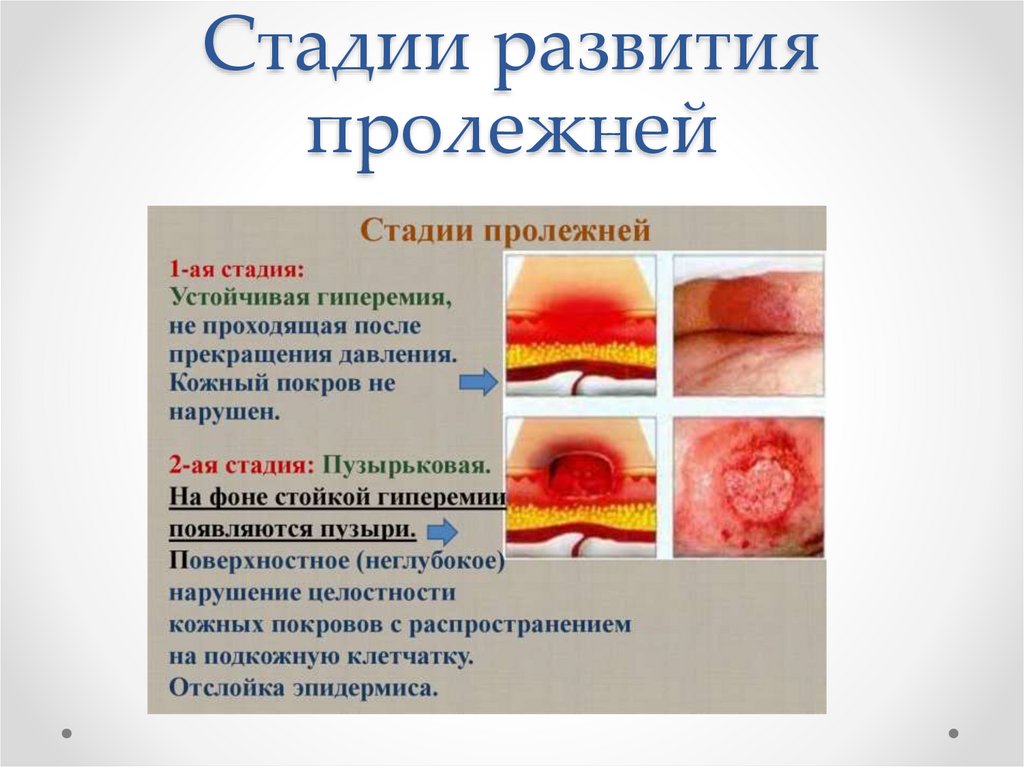 Стадии развития пролежней