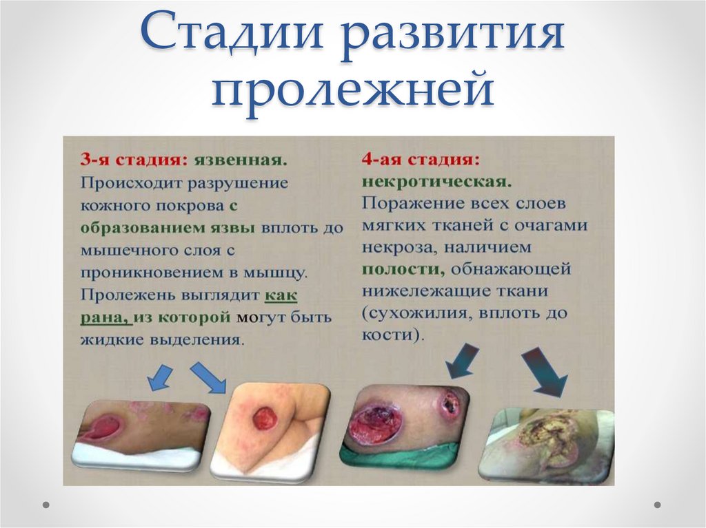 Стадии развития пролежней