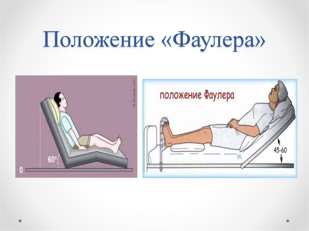 Положение «Фаулера»