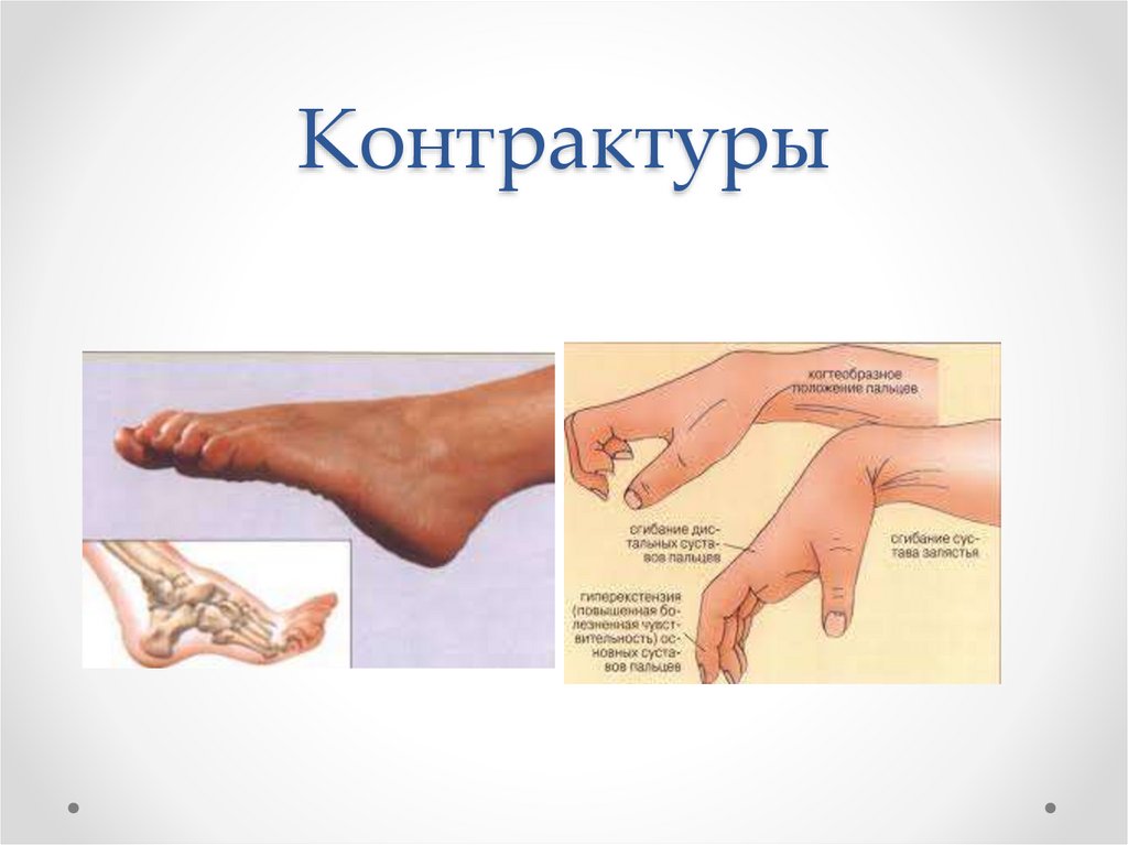 Контрактуры