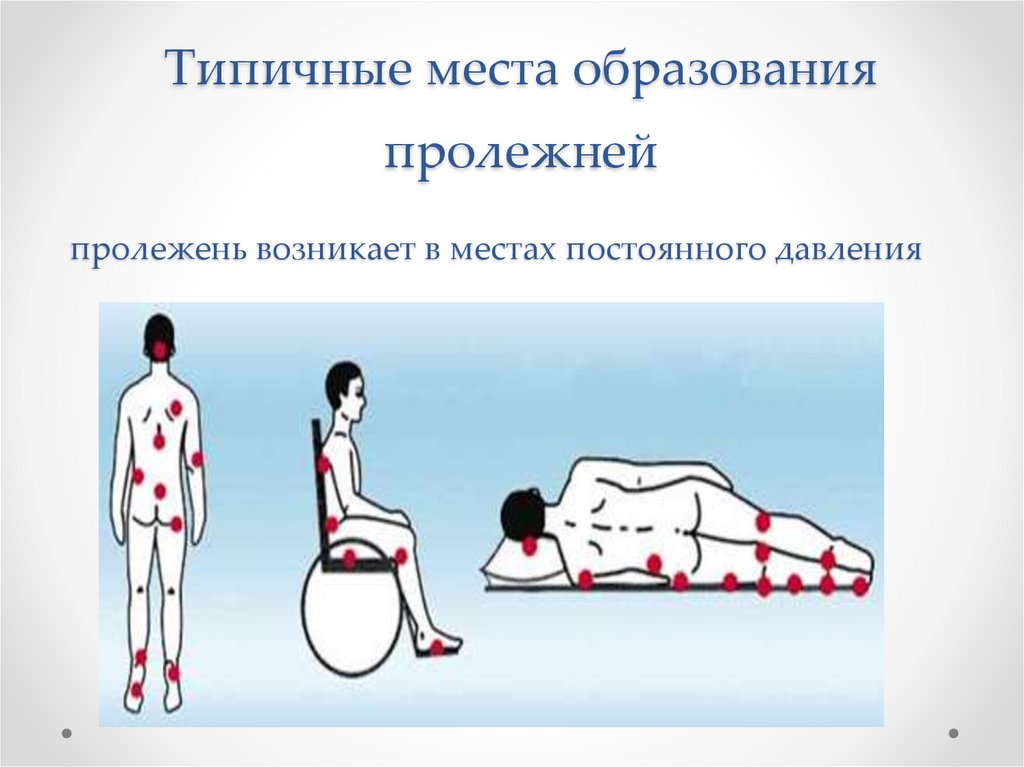 Типичные места образования пролежней