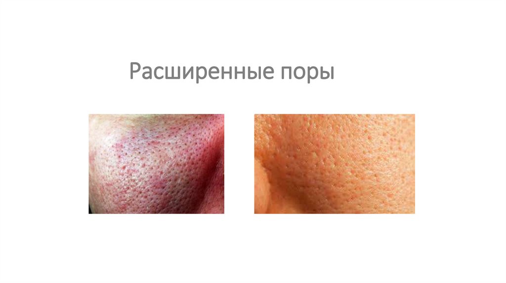 Расширенные поры